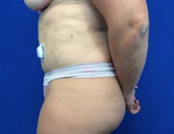 Tummy Tuck (Abdominoplasty) Before & After Gallery - Patient 4594917 - Image 6