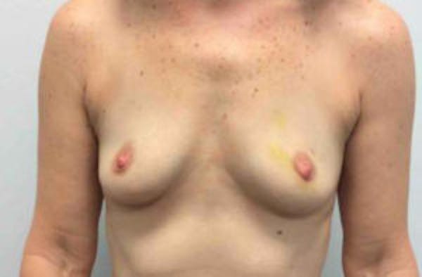 Breast Implant Reconstruction Before & After Gallery - Patient 4715918 - Image 1