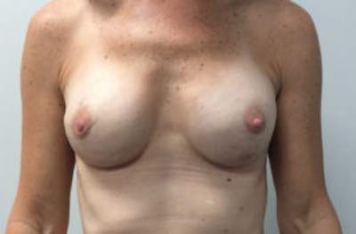 Breast Implant Reconstruction Before & After Gallery - Patient 4715918 - Image 2