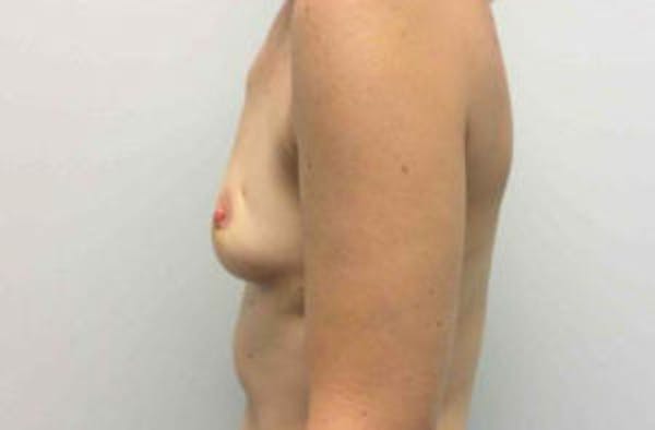 Breast Implant Reconstruction Before & After Gallery - Patient 4715918 - Image 3