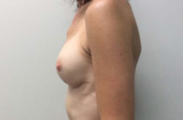 Breast Implant Reconstruction Before & After Gallery - Patient 4715918 - Image 4