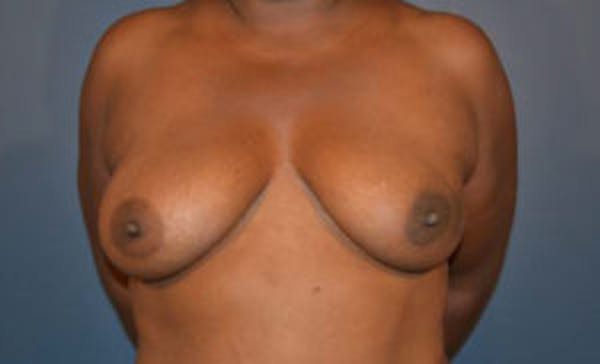 Breast Implant Reconstruction Before & After Gallery - Patient 4715919 - Image 1