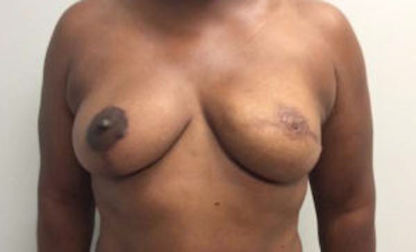 Breast Implant Reconstruction Before & After Gallery - Patient 4715919 - Image 2