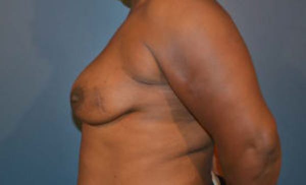 Breast Implant Reconstruction Before & After Gallery - Patient 4715919 - Image 3
