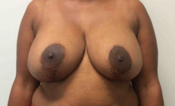 Breast DIEP Flap Reconstruction Before & After Gallery - Patient 4715872 - Image 1