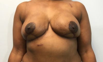 Breast DIEP Flap Reconstruction Before & After Gallery - Patient 4715872 - Image 2
