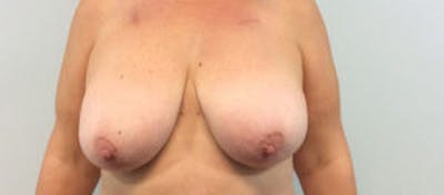 Breast DIEP Flap Reconstruction Before & After Gallery - Patient 4715873 - Image 1