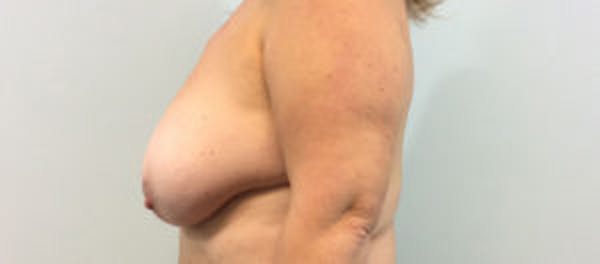 Breast DIEP Flap Reconstruction Before & After Gallery - Patient 4715873 - Image 3