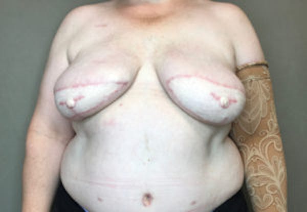 Breast DIEP Flap Reconstruction Before & After Gallery - Patient 4715874 - Image 2