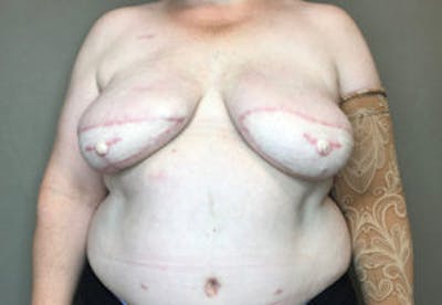 Breast DIEP Flap Reconstruction Before & After Gallery - Patient 4715874 - Image 2