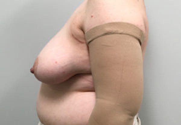 Breast DIEP Flap Reconstruction Before & After Gallery - Patient 4715874 - Image 3
