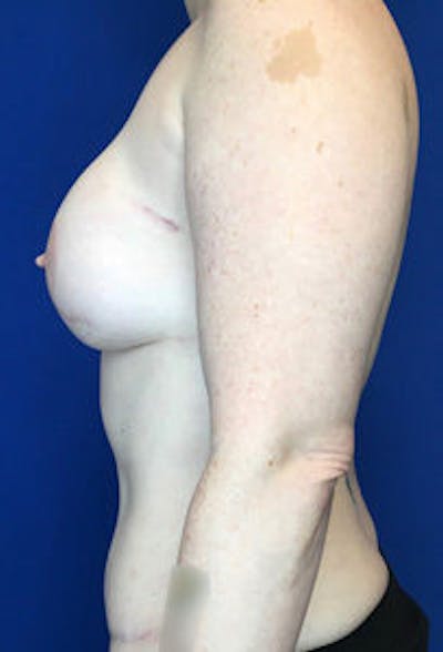 Breast DIEP Flap Reconstruction Gallery - Patient 4715875 - Image 4