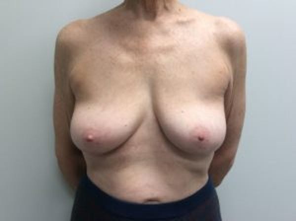 Breast Implant Reconstruction Before & After Gallery - Patient 4715920 - Image 1