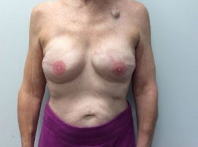 Breast Implant Reconstruction Before & After Gallery - Patient 4715920 - Image 2