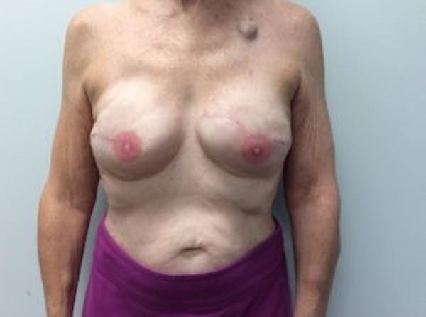 Breast Implant Reconstruction Before & After Gallery - Patient 4715920 - Image 2