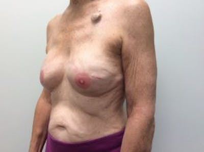 Breast Implant Reconstruction Before & After Gallery - Patient 4715920 - Image 4