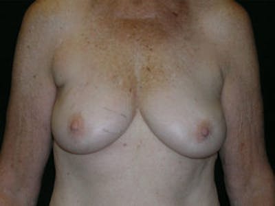 Breast DIEP Flap Reconstruction Before & After Gallery - Patient 4715876 - Image 1