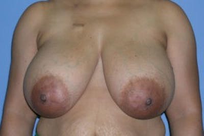 Breast DIEP Flap Reconstruction Before & After Gallery - Patient 4715877 - Image 1