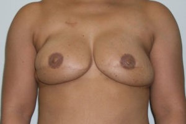Breast DIEP Flap Reconstruction Before & After Gallery - Patient 4715877 - Image 2