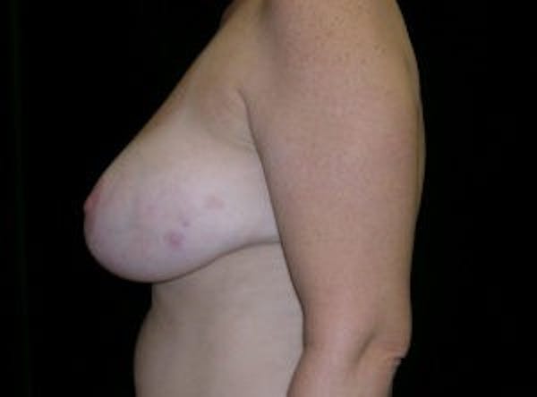 Breast DIEP Flap Reconstruction Before & After Gallery - Patient 4715882 - Image 3