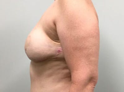 Breast DIEP Flap Reconstruction Before & After Gallery - Patient 4715882 - Image 4