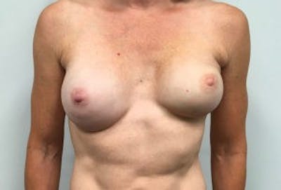 Breast DIEP Flap Reconstruction Before & After Gallery - Patient 4715883 - Image 1