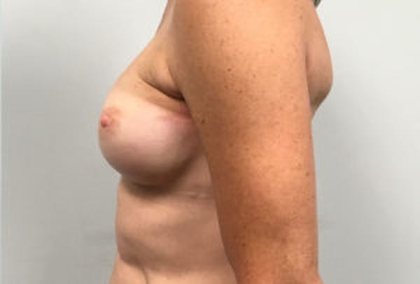 Breast DIEP Flap Reconstruction Before & After Gallery - Patient 4715883 - Image 3