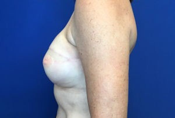 Breast DIEP Flap Reconstruction Before & After Gallery - Patient 4715883 - Image 4