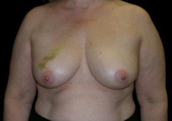 Breast DIEP Flap Reconstruction Before & After Gallery - Patient 4715890 - Image 1
