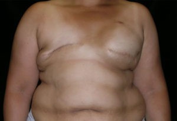 Breast DIEP Flap Reconstruction Before & After Gallery - Patient 4715891 - Image 1