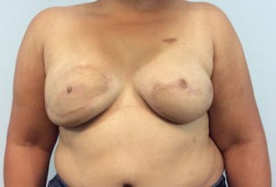 Breast DIEP Flap Reconstruction Before & After Gallery - Patient 4715891 - Image 2