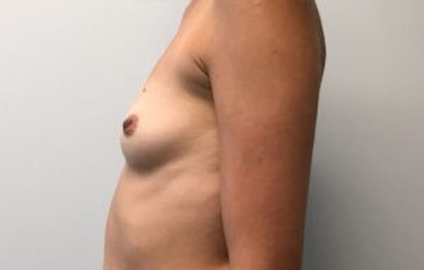 Breast Implant Reconstruction Before & After Gallery - Patient 4715921 - Image 3