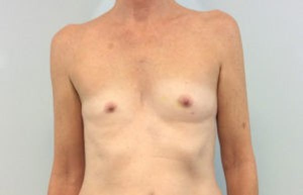 Breast Implant Reconstruction Before & After Gallery - Patient 4715922 - Image 1