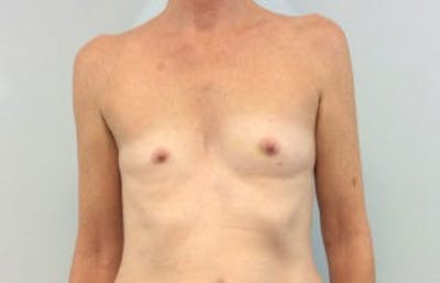 Breast Implant Reconstruction Before & After Gallery - Patient 4715922 - Image 1