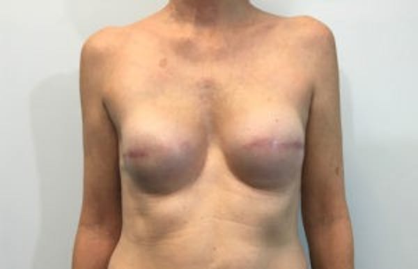 Breast Implant Reconstruction Before & After Gallery - Patient 4715922 - Image 2