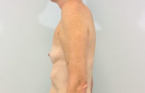 Breast Implant Reconstruction Before & After Gallery - Patient 4715922 - Image 3