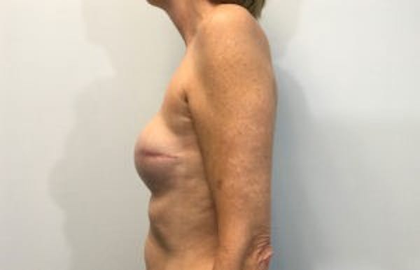 Breast Implant Reconstruction Before & After Gallery - Patient 4715922 - Image 4