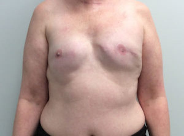 Breast Implant Reconstruction Before & After Gallery - Patient 4715944 - Image 1