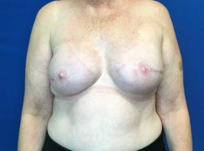 Breast Implant Reconstruction Before & After Gallery - Patient 4715944 - Image 2