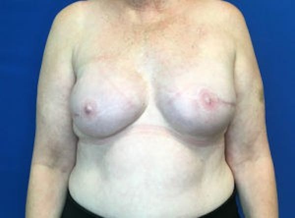 Breast Implant Reconstruction Before & After Gallery - Patient 4715944 - Image 2