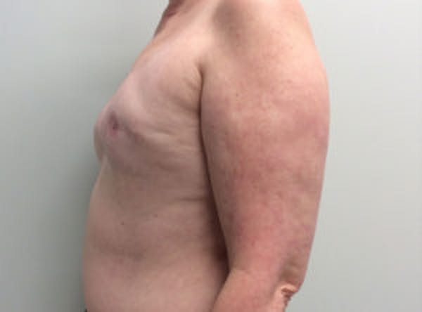 Breast Implant Reconstruction Before & After Gallery - Patient 4715944 - Image 3