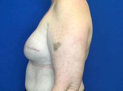 Breast Implant Reconstruction Before & After Gallery - Patient 4715944 - Image 4