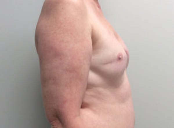 Breast Implant Reconstruction Before & After Gallery - Patient 4715944 - Image 5