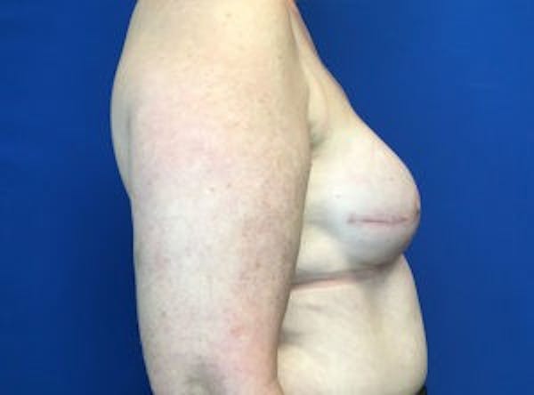 Breast Implant Reconstruction Gallery - Patient 4715944 - Image 6