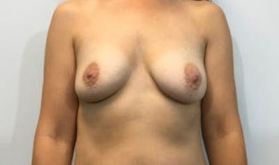 Breast Implant Reconstruction Before & After Gallery - Patient 45391197 - Image 1