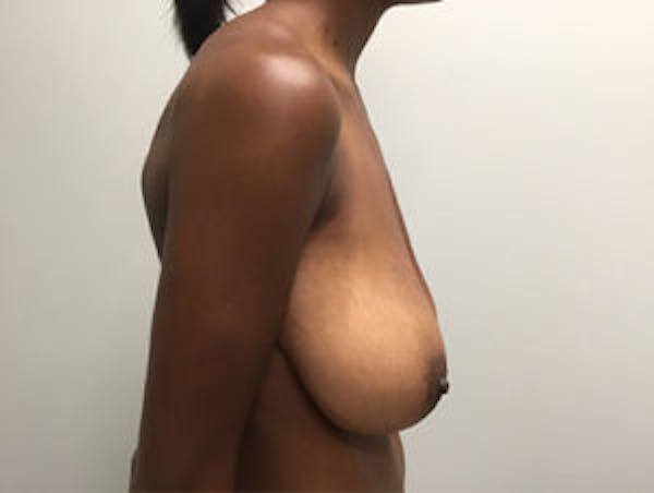 Breast Reduction Before & After Gallery - Patient 4594937 - Image 3