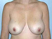 Breast Reduction