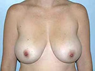 Breast Reduction Before & After Gallery - Patient 4594938 - Image 1