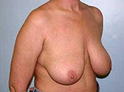 Breast Reduction