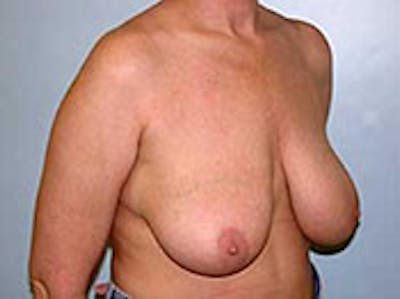 Breast Reduction Before & After Gallery - Patient 4594939 - Image 1